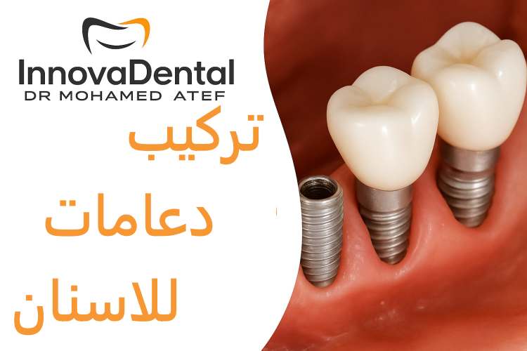 تركيب دعامات للاسنان بعد الخلع أو الزراعة: الدليل الكامل